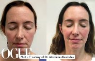 One-Woman-Gets-15-Cosmetic-Procedures-in-12-Months-Vogue